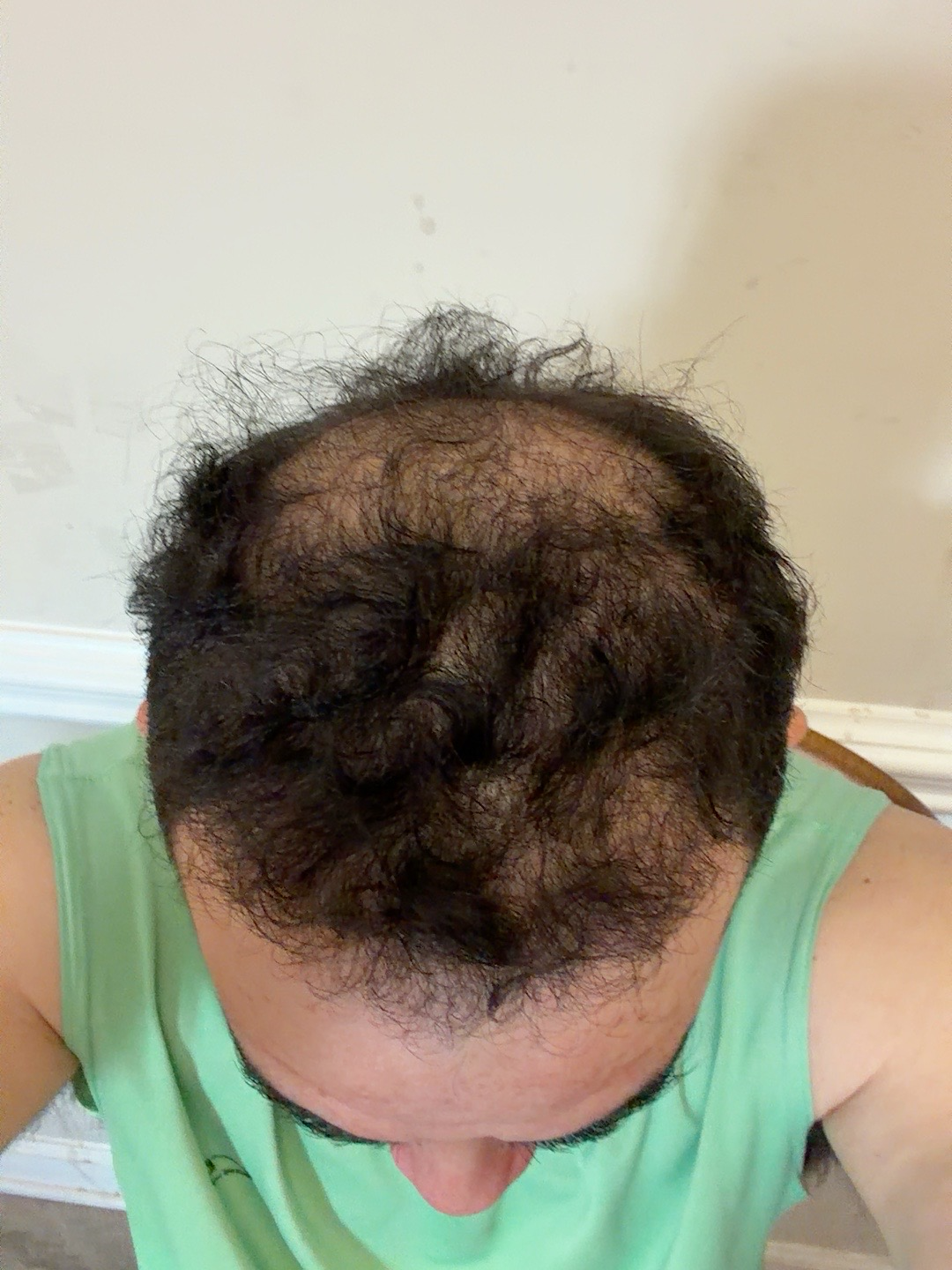 Mi experiencia con la pérdida de cabello